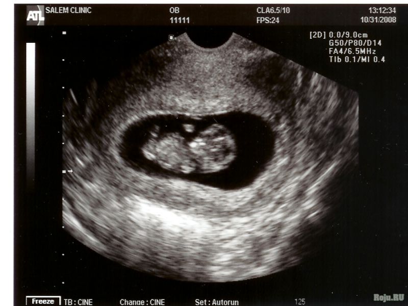Снимок эмбриона с УЗИ