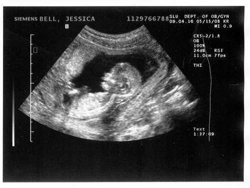 Эмбрион на снимке УЗИ