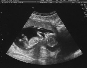 УЗИ первого триместра беременности