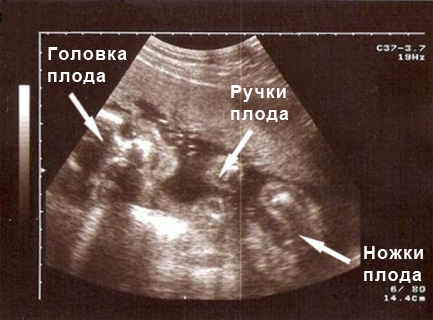 Эмбрион на УЗ-исследовании