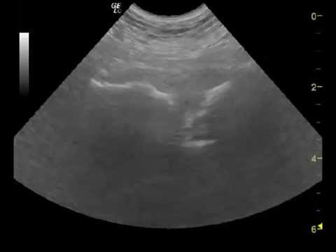 УЗИ симфиза: зачем делать УЗИ лонного сочленения при беременности. Анатомия и патогенез. Лечение и профилактика
