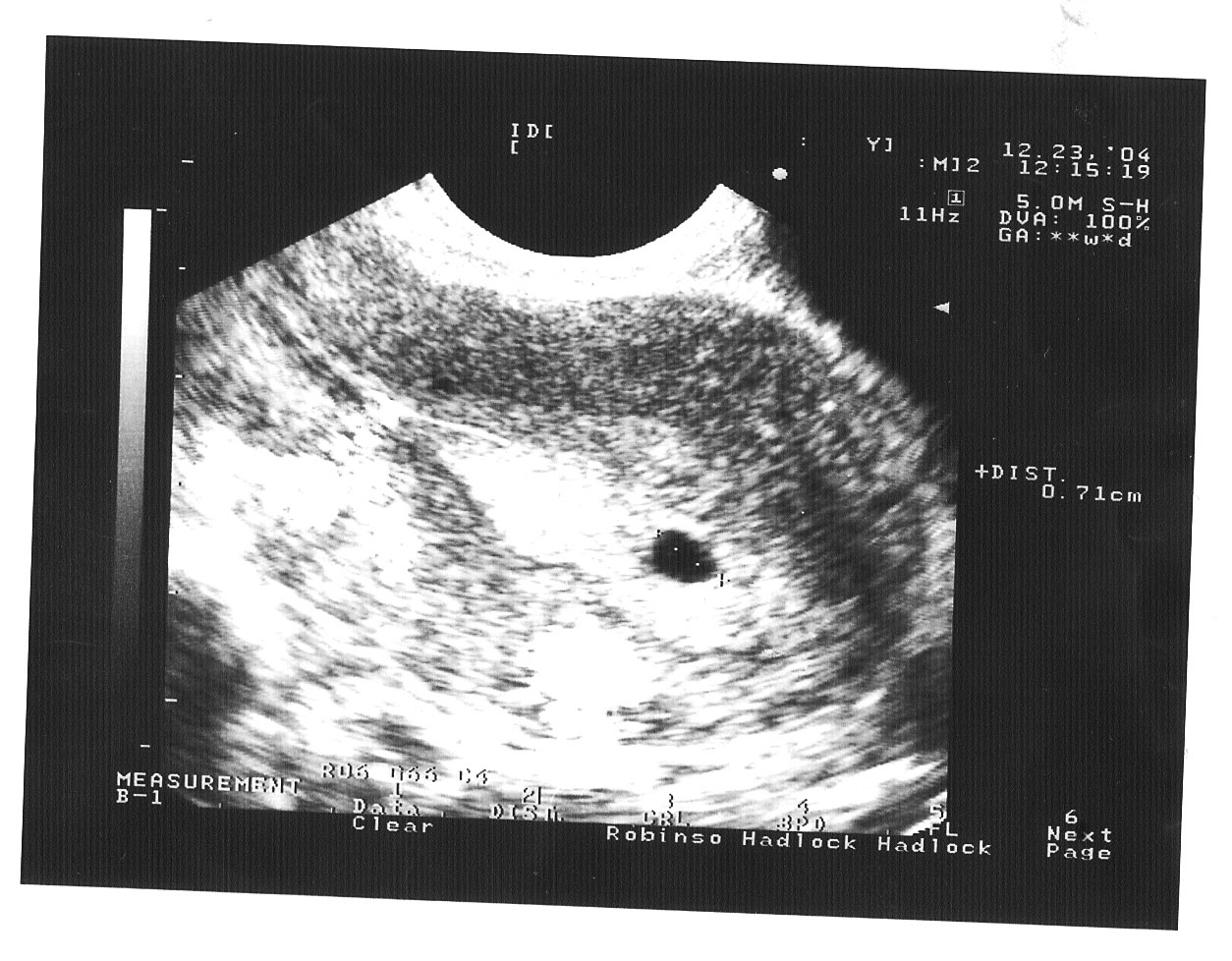 5 недель после зачатия. Беременность на пятой неделе