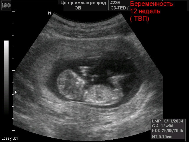 Снимок с УЗИ на 12 неделе беременности
