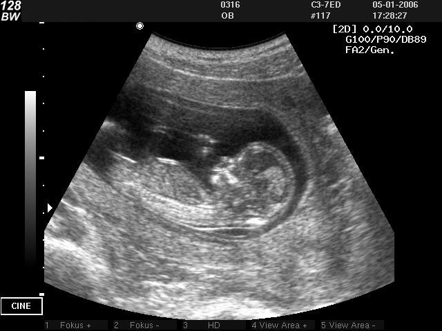УЗИ-снимок эмбриона в утробе