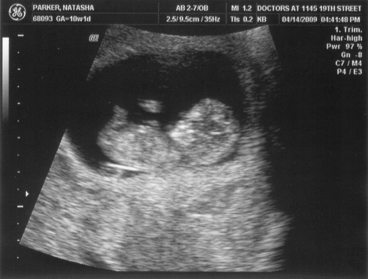 Эмбрион на 11 неделе беременности