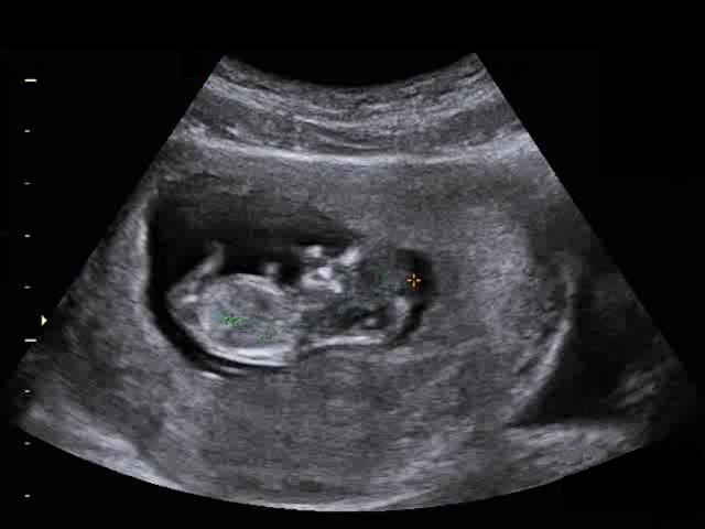 ПЛод на 11 неделе беременности