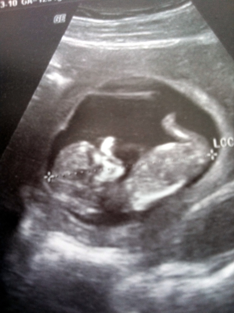 УЗИ-снимок эмбриона в утробе