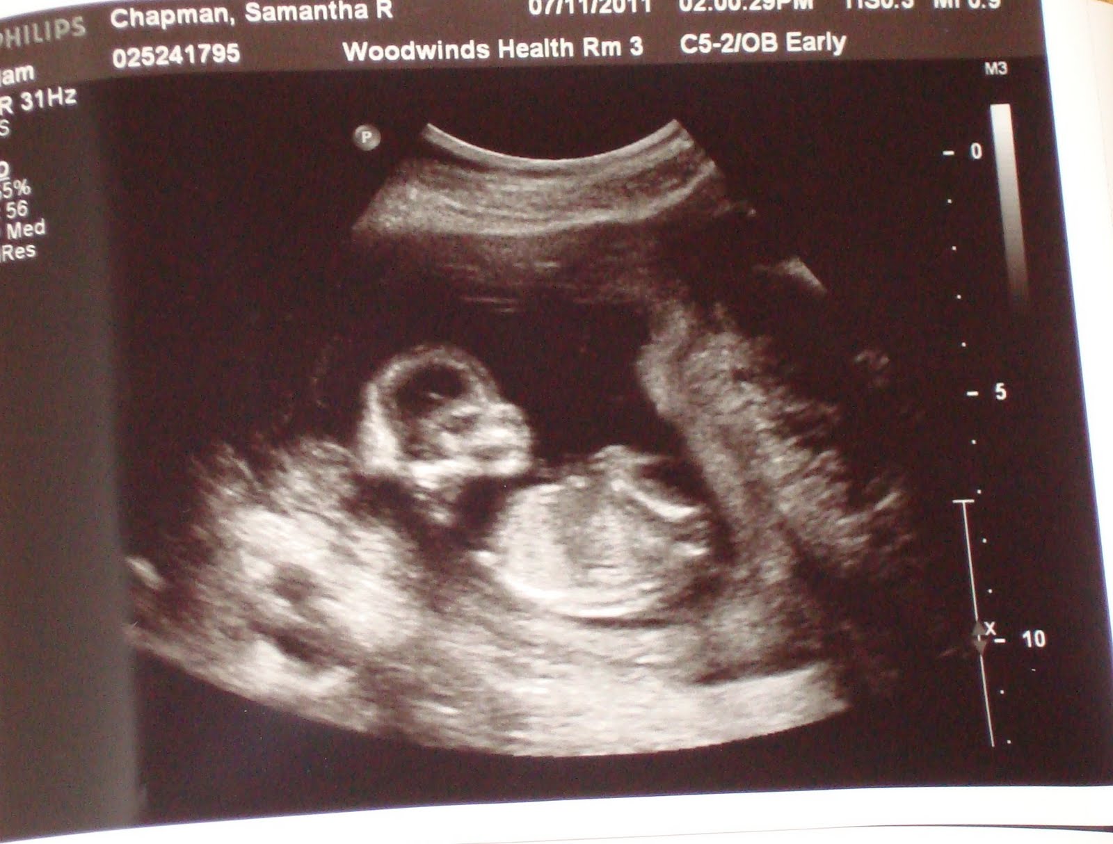 Снимок эмбриона в матке