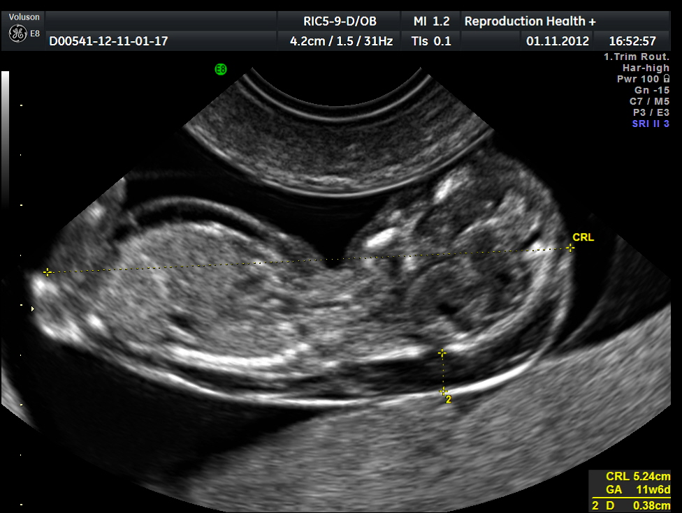 Эмбрион во время УЗИ