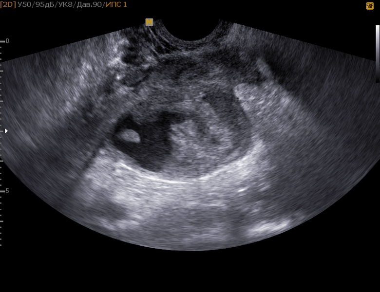 УЗ-снимок кисты в яичнике на исследовании