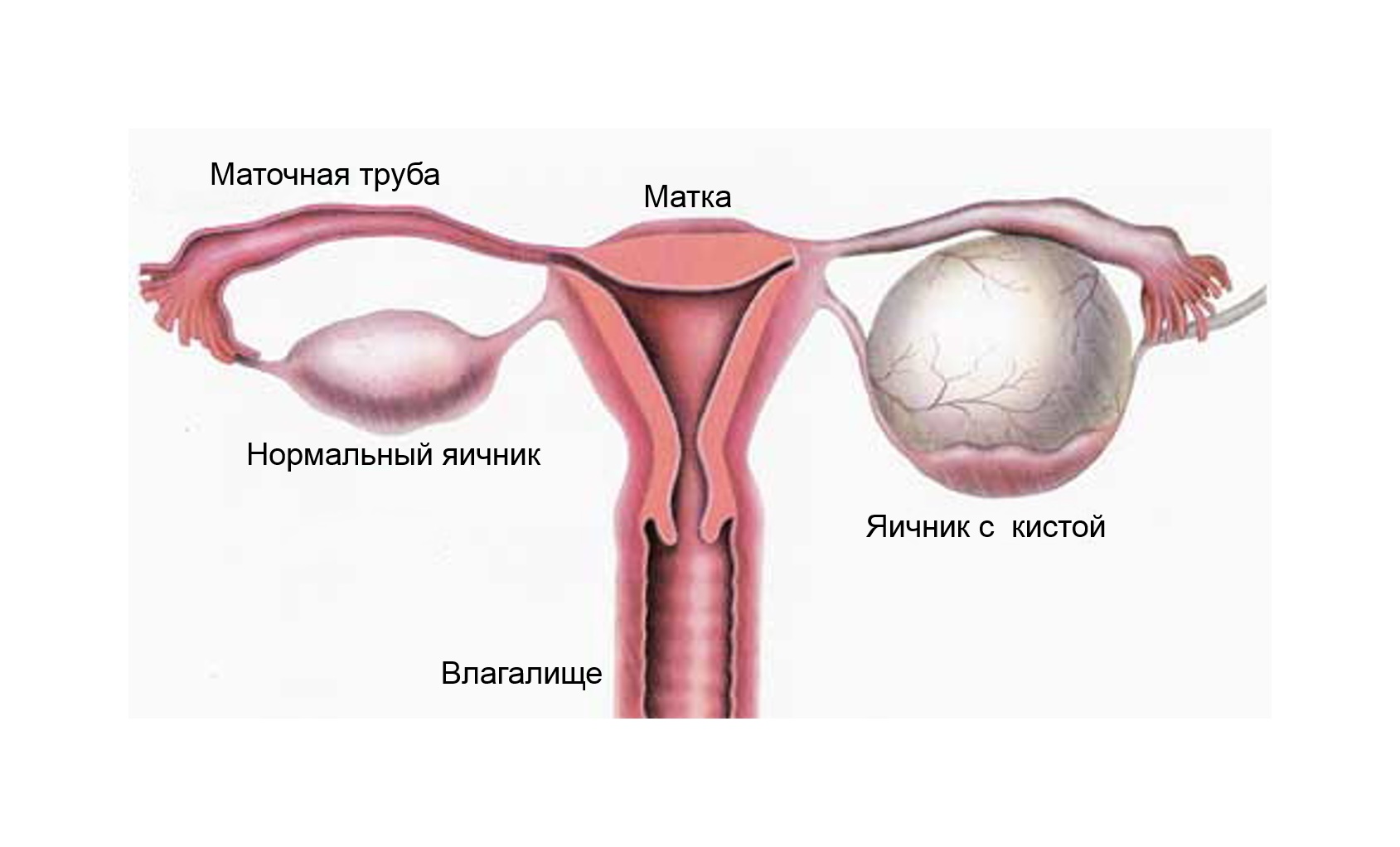 Схема кисты в яичнике