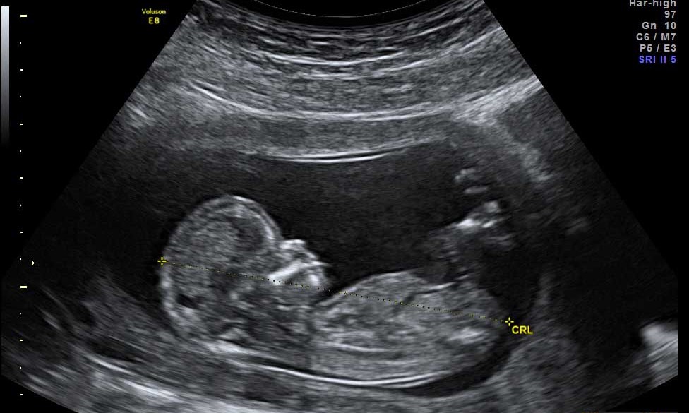 Вторая беременность 15 недель. Запреты и противопоказания при беременности. Стоит ли делать УЗИ