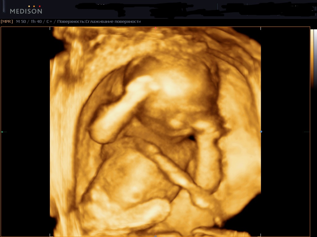 Эмбрион в матке
