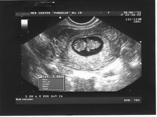 Эмбрион на сроке в 10 недель на УЗИ