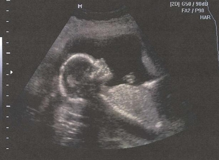 Снимок с УЗИ при беременности
