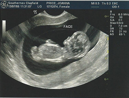 Эмбрион на УЗИ