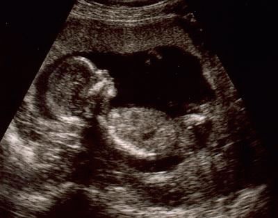 Эмбрион на 17 неделе