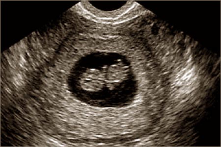 Эмбрион на УЗИ-снимке