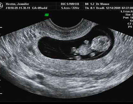 Эмбрион на 9 неделе беременности