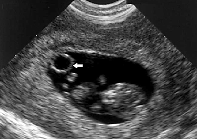 Снимок эмбриона на УЗИ