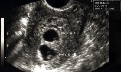 Снимок с УЗИ для беременной двумя плодами
