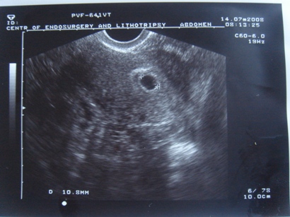 Снимок УЗИ беременной