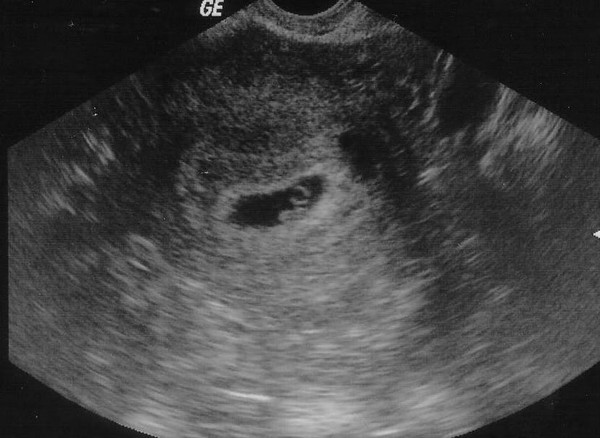 Эмбрион на первых неделях жизни