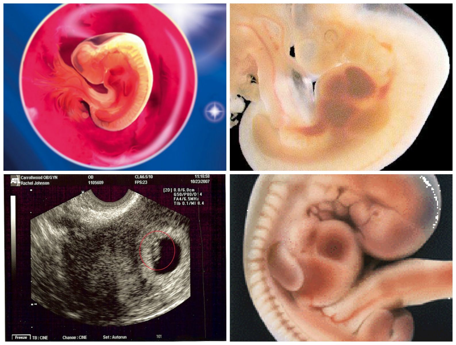 Тянет поясницу на 5 неделе беременности от зачатия thumbnail
