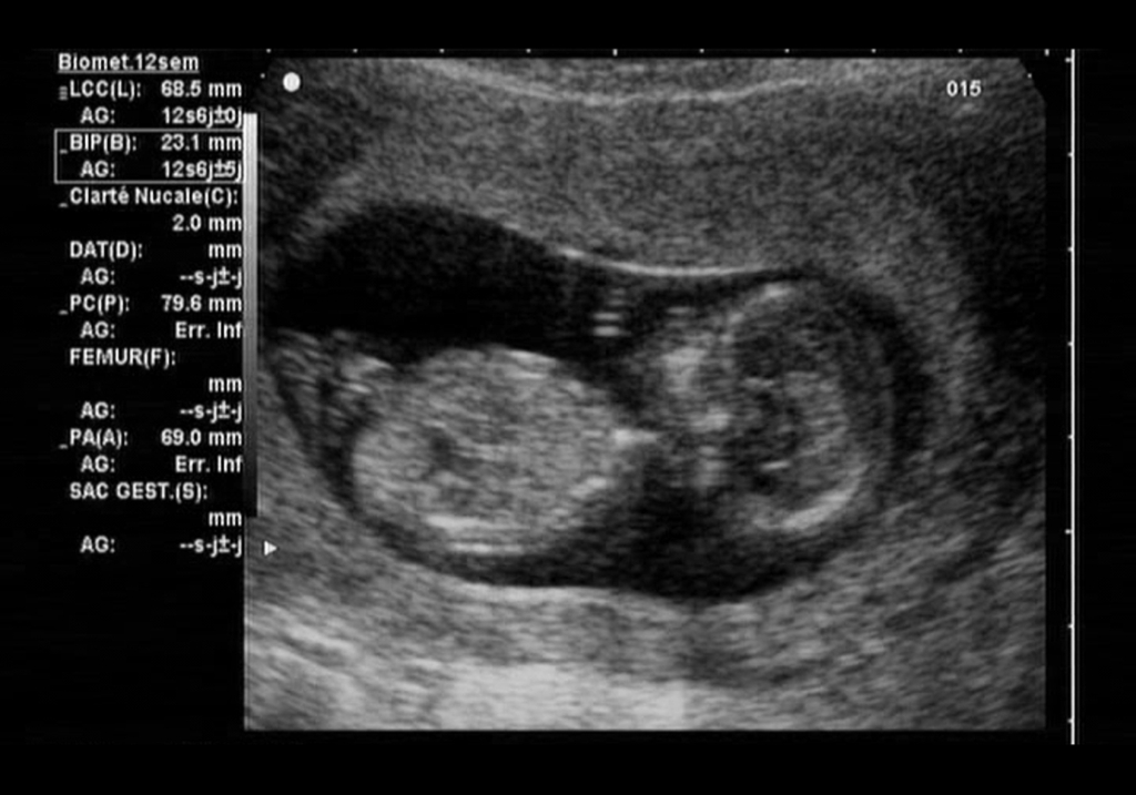 12 недель беременности размер плода фото узи скрининг thumbnail