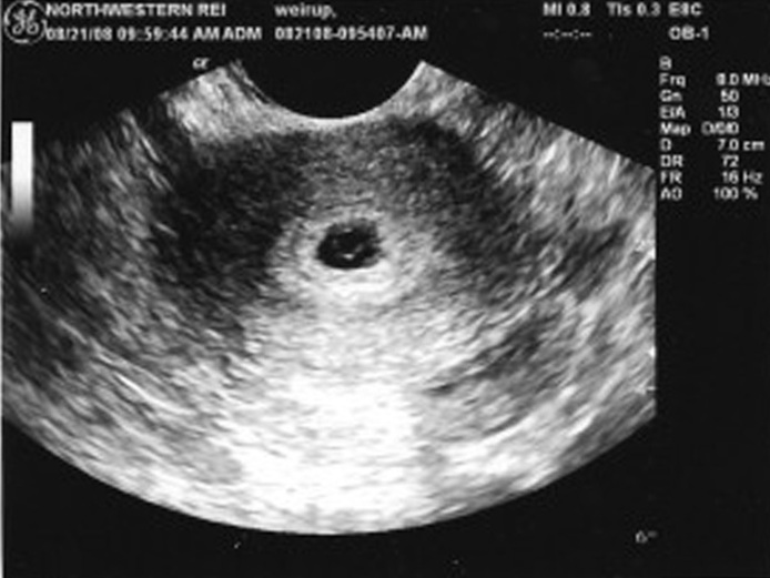 Узи на 5 неделе беременности снимок узи thumbnail