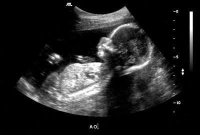 Плод ребенка на 22 неделе развития и его пол thumbnail