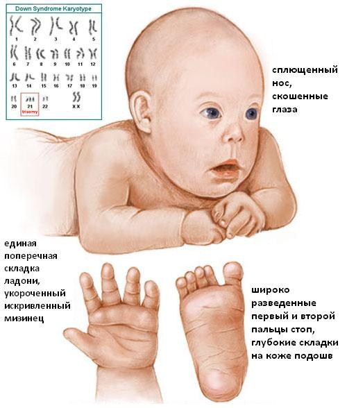 Младенец с синдромом Дауна