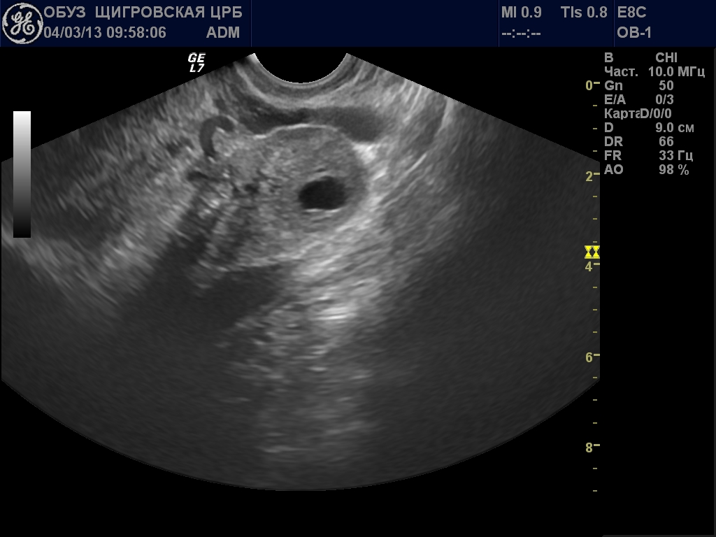 Тянет яичник при беременности на ранних. Лютеиновая киста яичника. Лютеиновые кисты яичника. Текалютеиновая киста яичника УЗИ.
