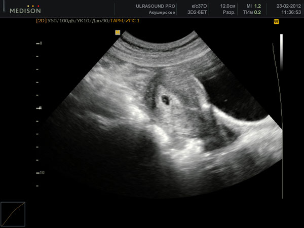 На каком сроке беременности можно увидеть эмбрион в плодном яйце на узи thumbnail