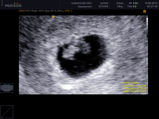 На каком сроке беременности можно увидеть эмбрион на узи thumbnail